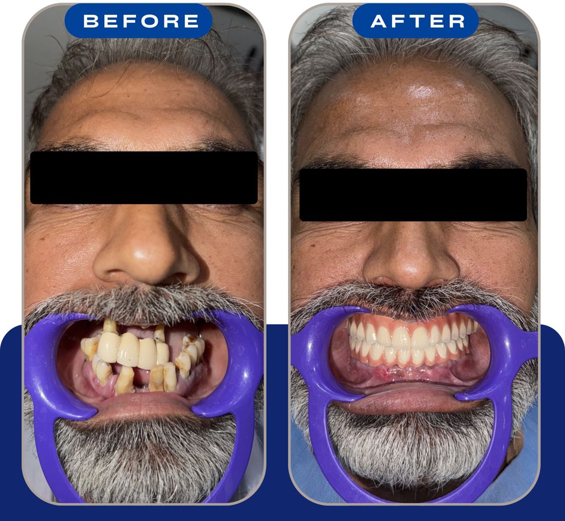 Before and after: failing bridge and loose teeth replaced with full fixed implant teeth