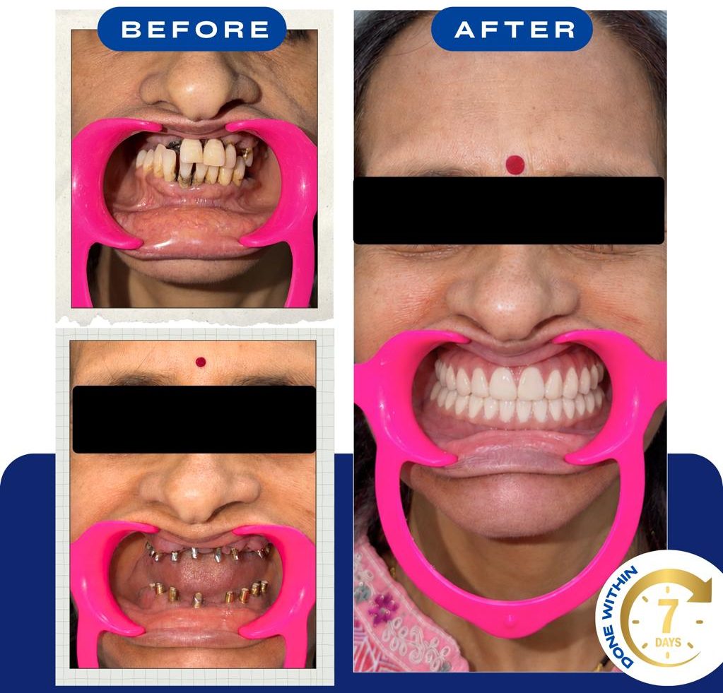 Before, implants placed, and after: worn and missing teeth replaced with full fixed upper and lower implant teeth