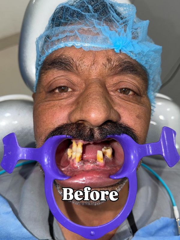 Before treatment: broken and missing upper teeth