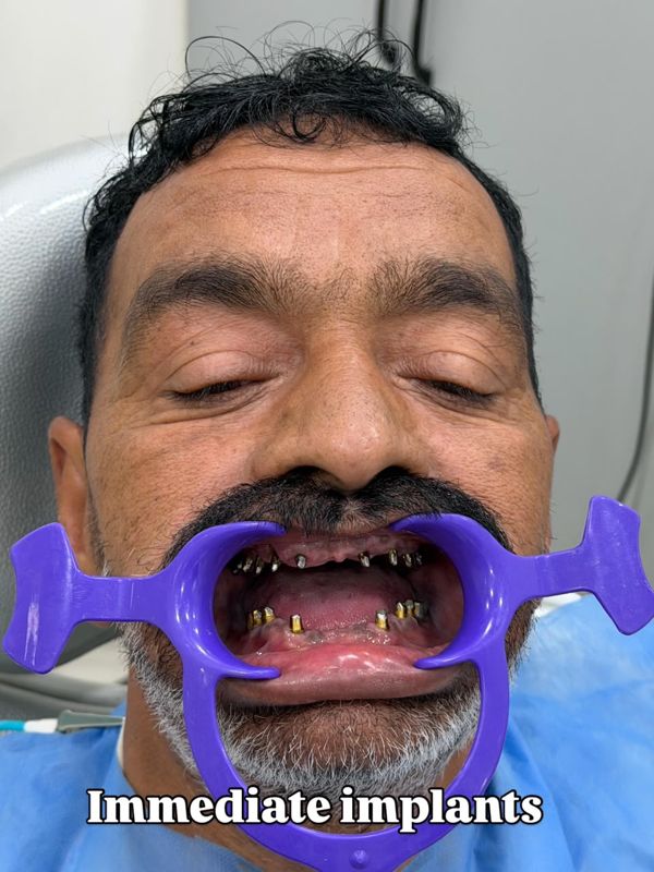Immediate implants placed in upper and lower jaws