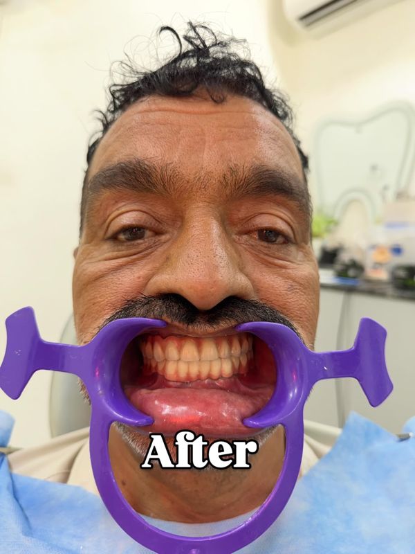 After: full fixed implant teeth fitted