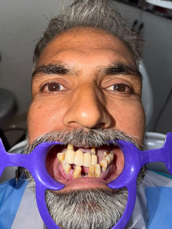 Before treatment: failing bridge and loose, decayed teeth
